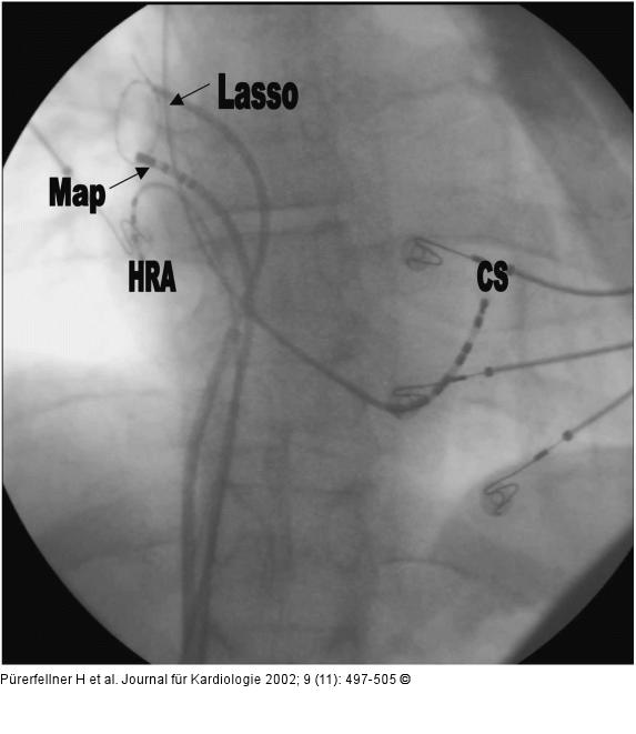 Pulmonalvenenangiographie