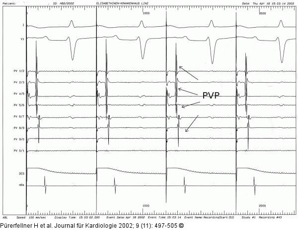Paroxysmales Vorhofflimmern - Mapping