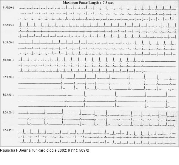 Sinusarrest - Karotis-Sinus-Syndrom