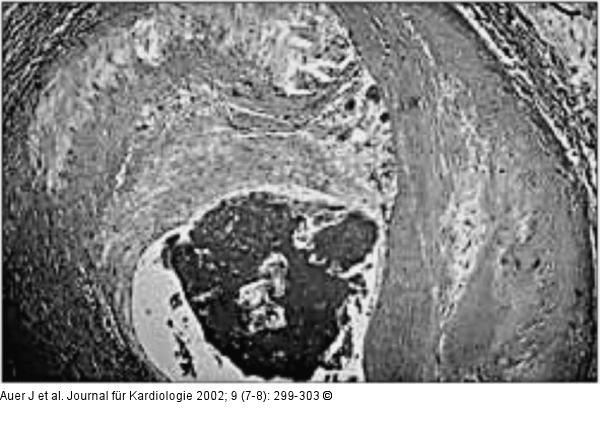 Akute Koronarsyndrome - Thrombusbildung - Plttchenaggregation