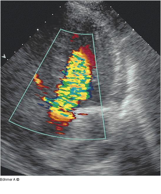 Aorteninsuffizienz