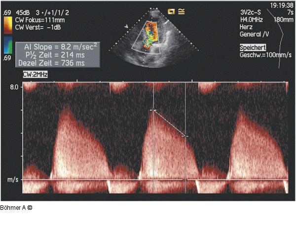 Aorteninsuffizienz