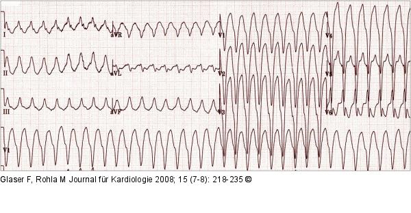 EKG