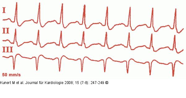 EKG