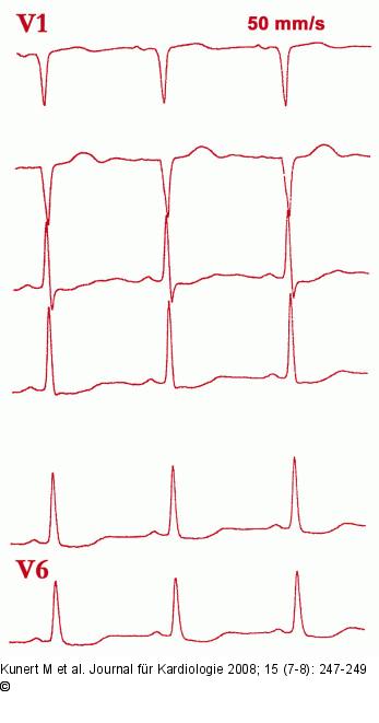EKG