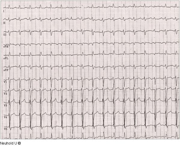EKG