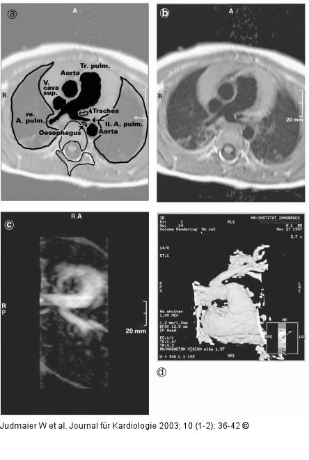 Magnetresonanzangiographie, Arteria pulmonalis