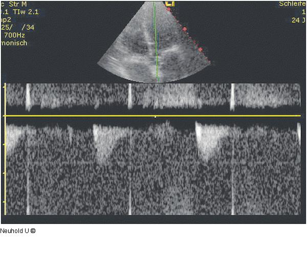 LVOT-VTI