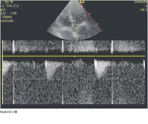 LVOT-VTI