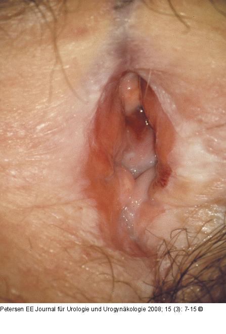 Lichen planus