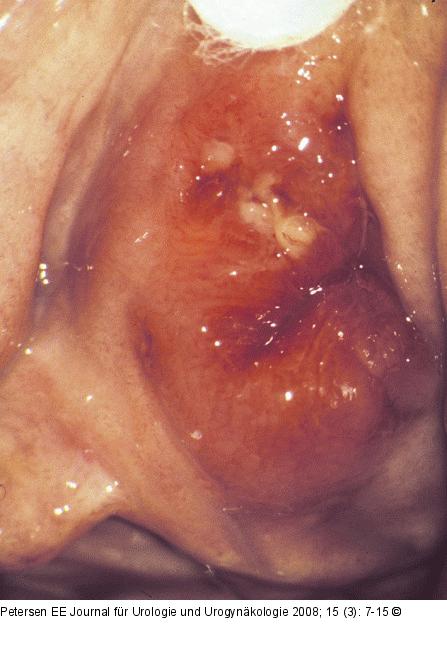 Herpes urethralis