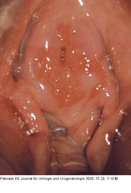 Vulvitis - Kolpitis