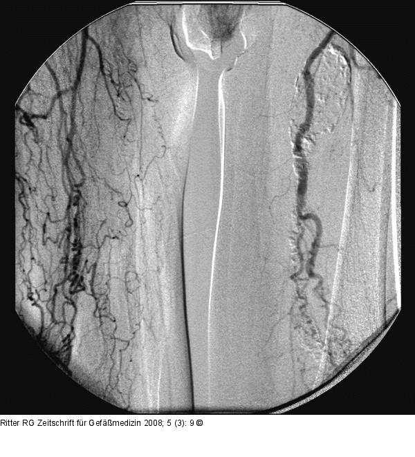 Aneursyma