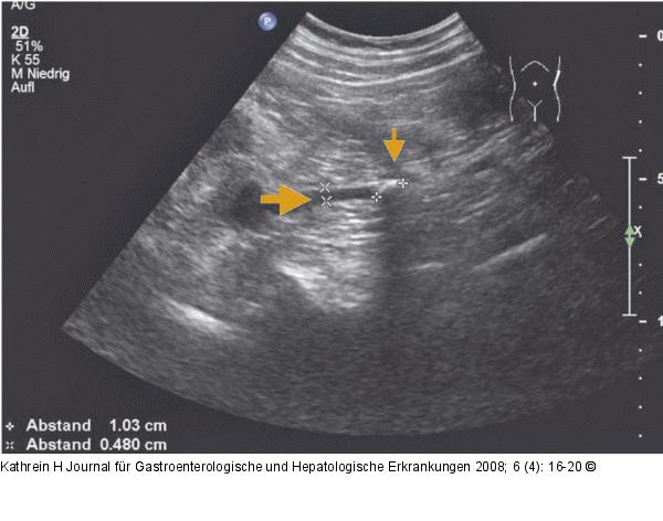 Ureterkonkrement