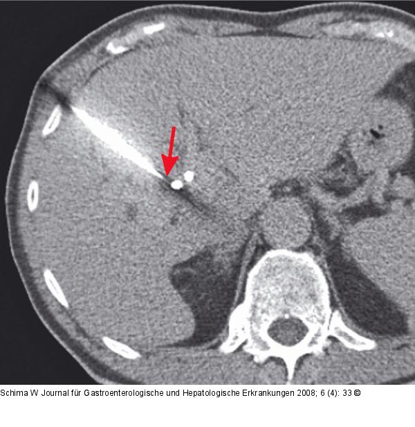 Tumor