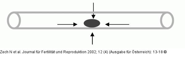 Straw - Klteverteilung