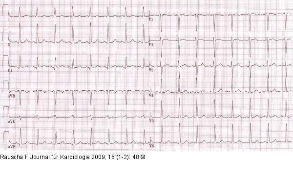 EKG