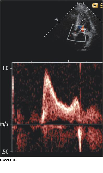 Gepulster Doppler