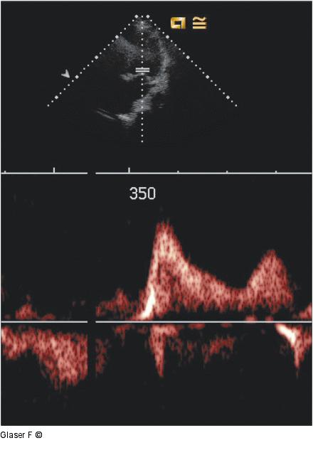 Gepulster Doppler