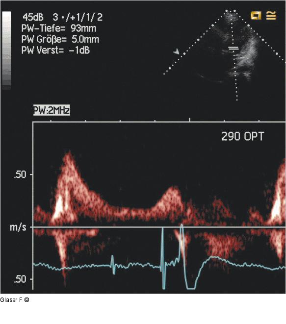 Gepulster Doppler