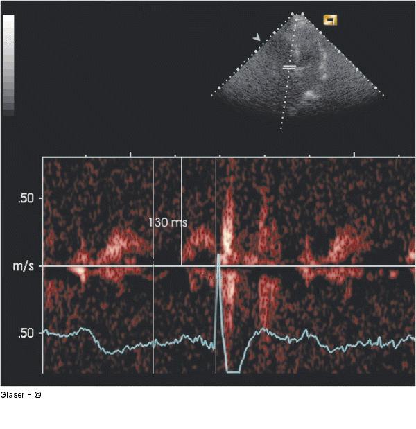 Gepulster Doppler