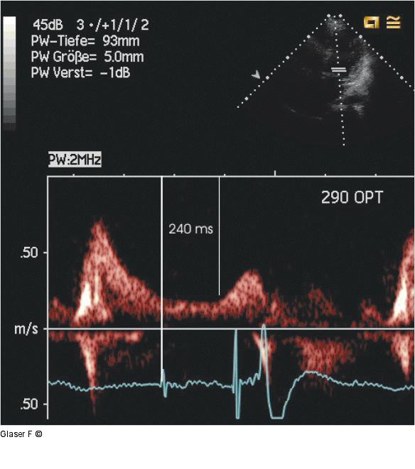 Gepulster Doppler