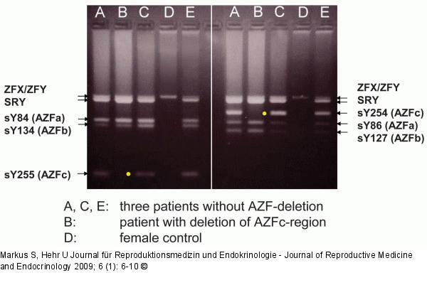 AZF deletion
