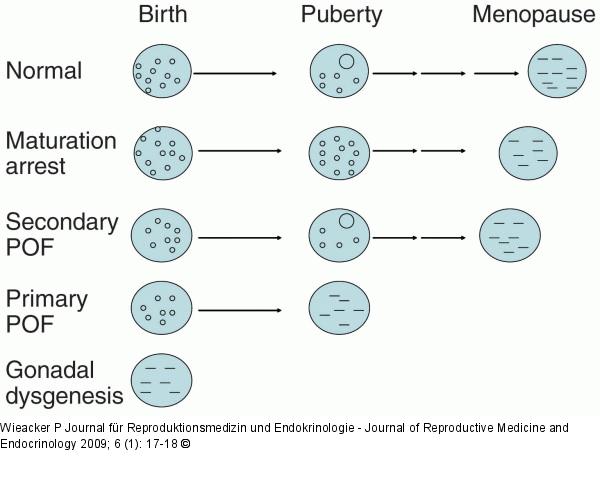 primary amenorrhoea