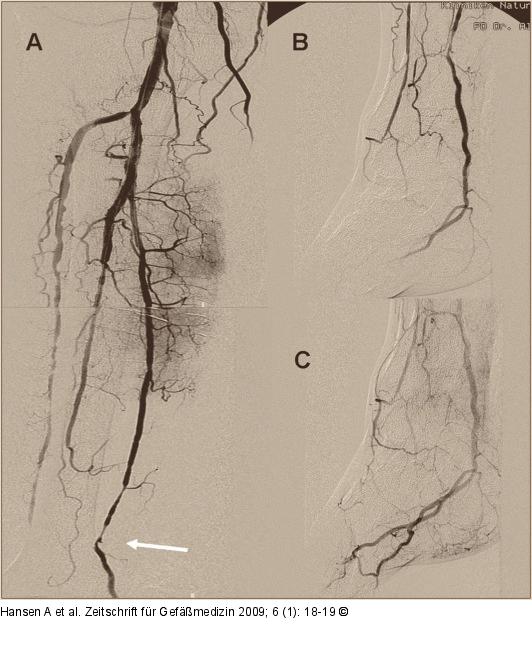 Arteria tib. posterior