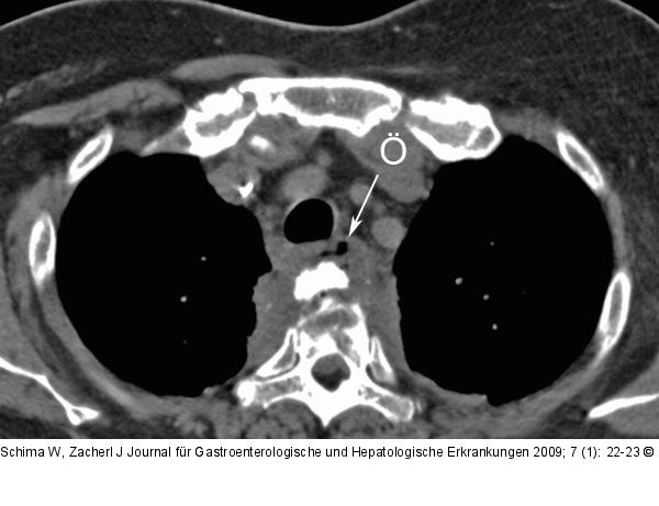 Mediastinum