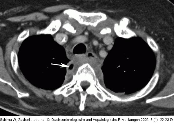 Mediastinum