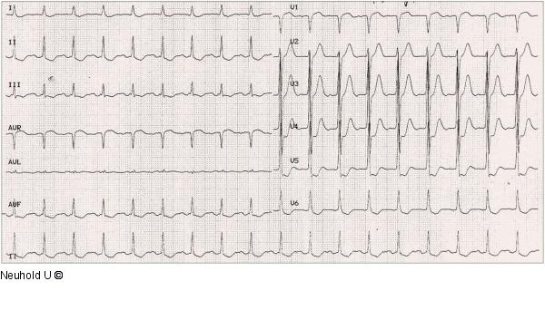 EKG