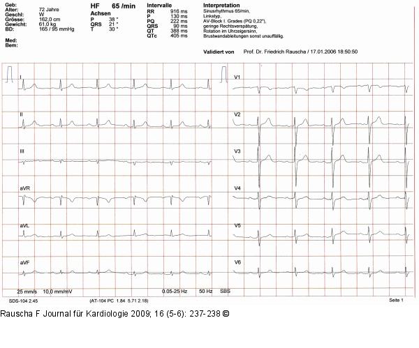 EKG
