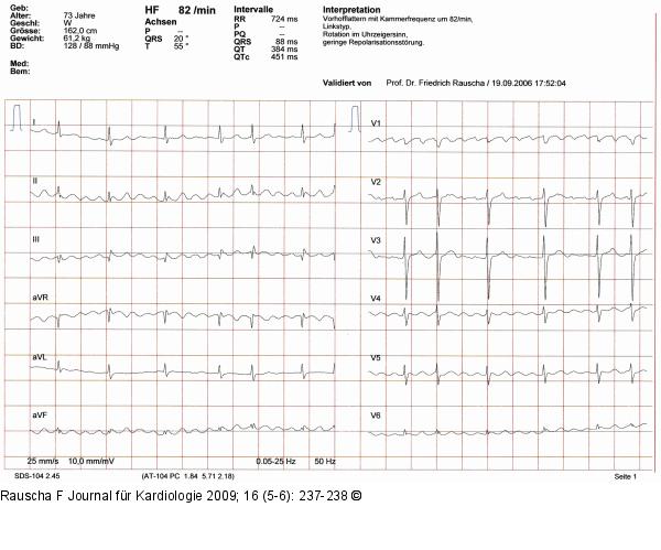 EKG