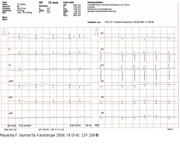 EKG