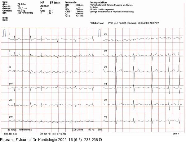 EKG