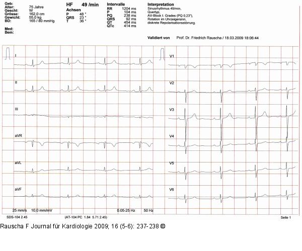 EKG