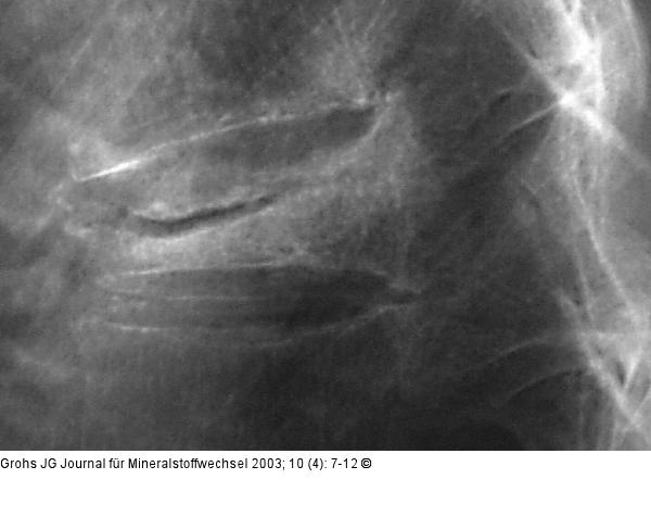 Pseudoarthrose