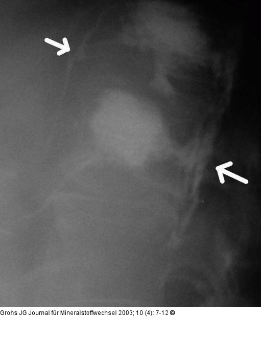 Vertebroplastik - Zementabflu