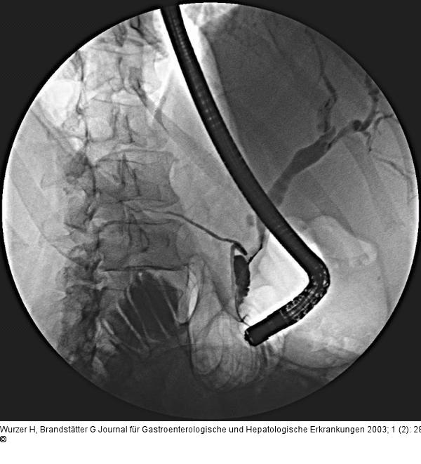 Ductus choledochus - Stenose