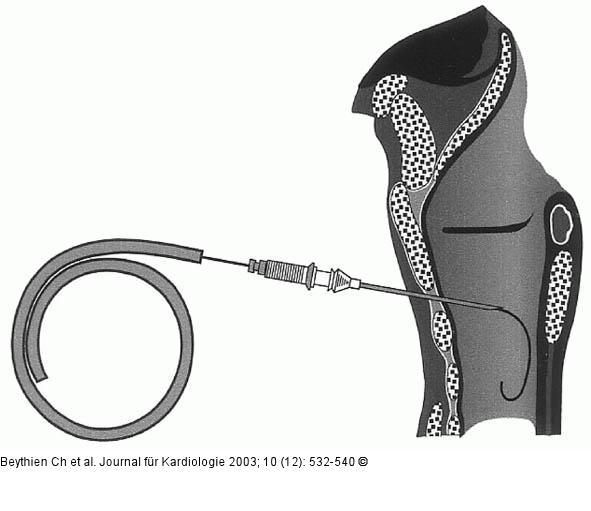Perkutane Dilatationstracheotomie