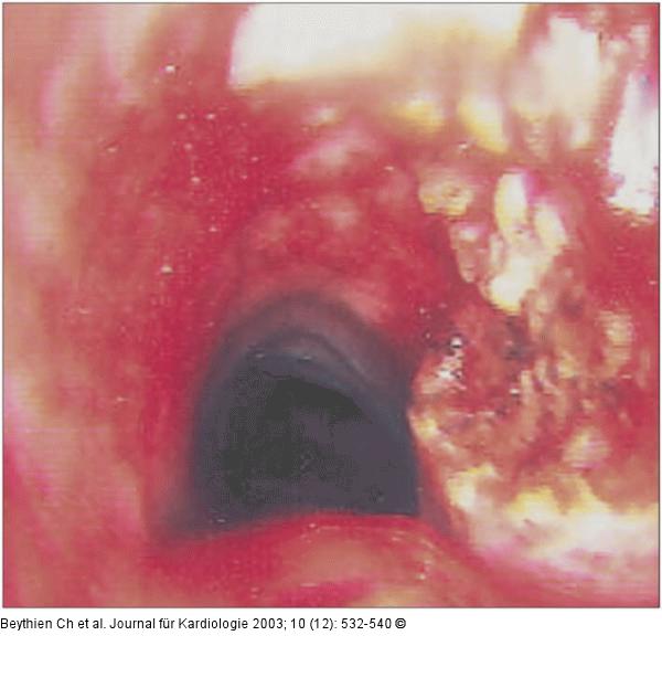 Trachea - Stenose - Lasertherapie
