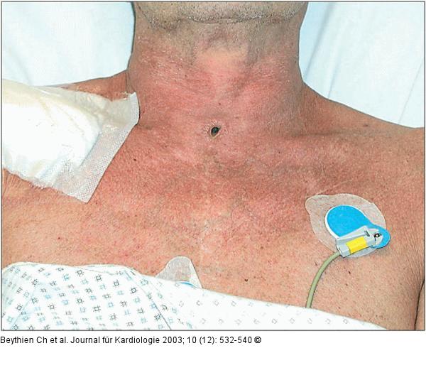 Perkutane Dilatationstracheotomie