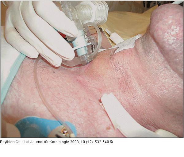Perkutane Tracheotomie - Trachealkanle
