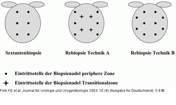 Prostatabiopsie - Technik