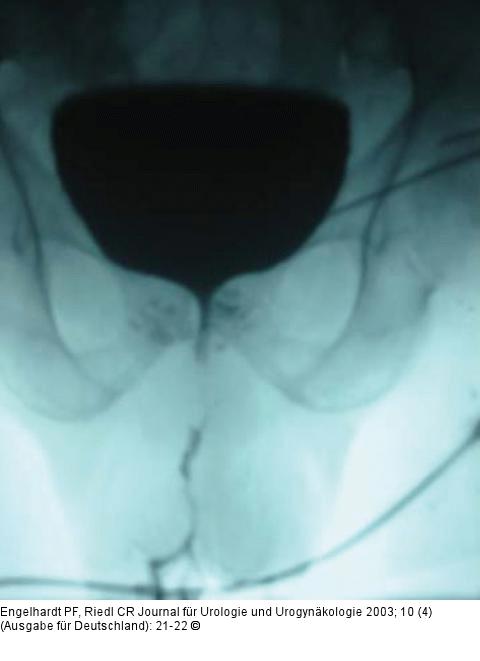 Urethrostoma