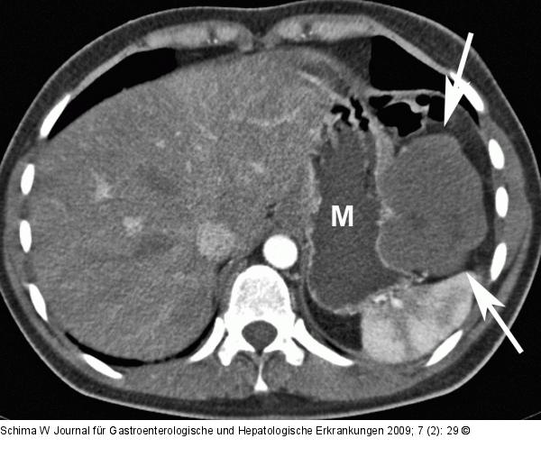 Hydro-MDCT