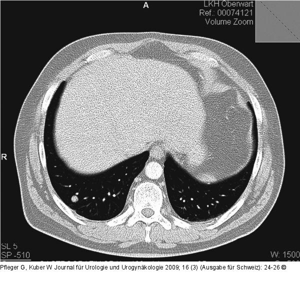 Lungenmetastase