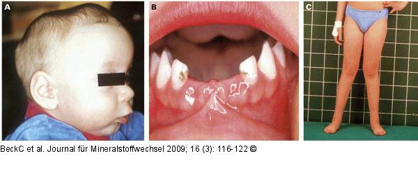 Hypophosphatasie