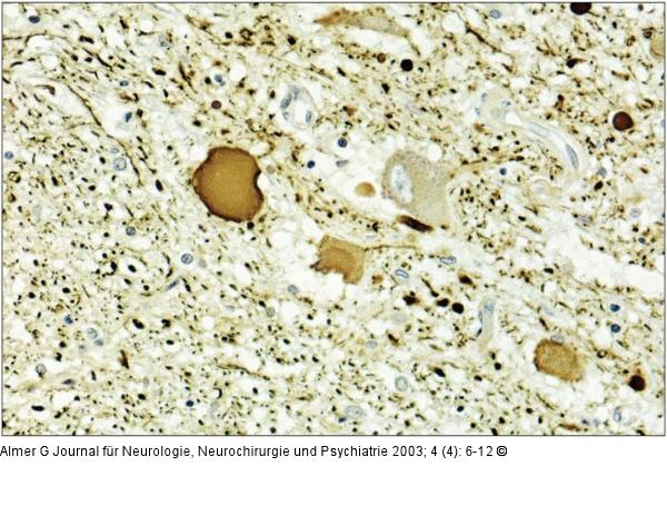 ALS - Neuropathologie
